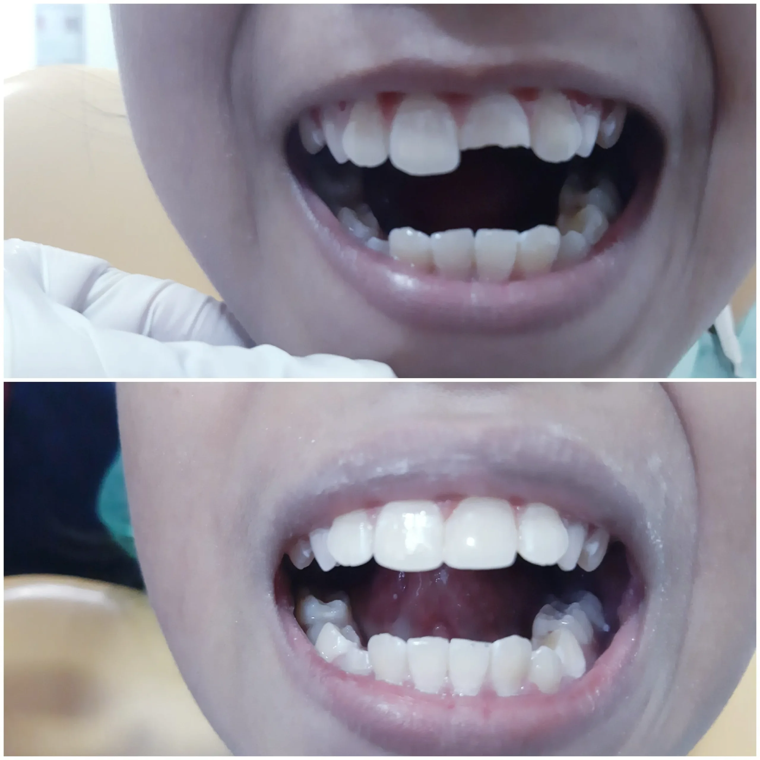 Composite bonding veneer before after Bali dental clinic