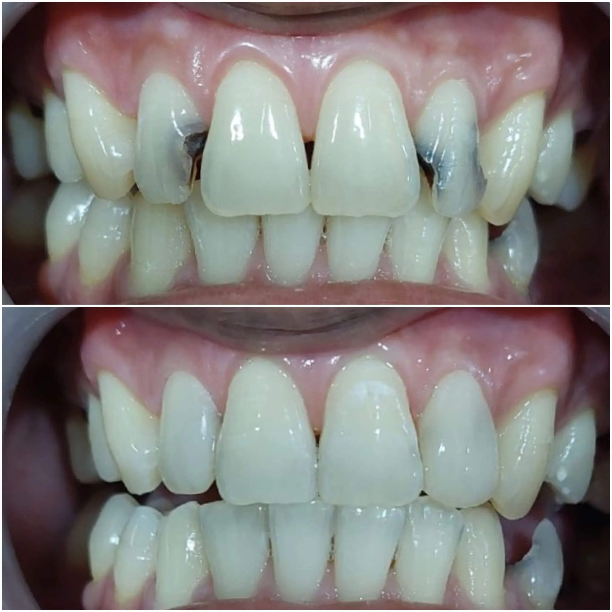 Composite filling front tooth before after Bali dentist