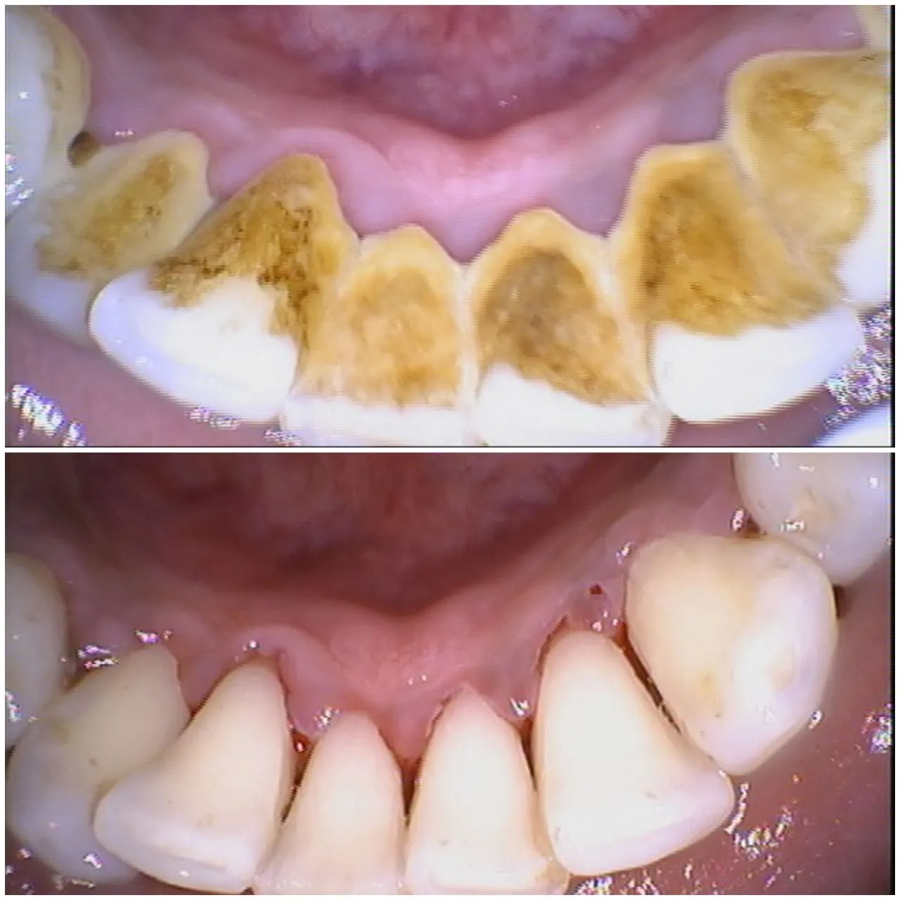 Professional teeth scaling cleaning before after Bali dentist