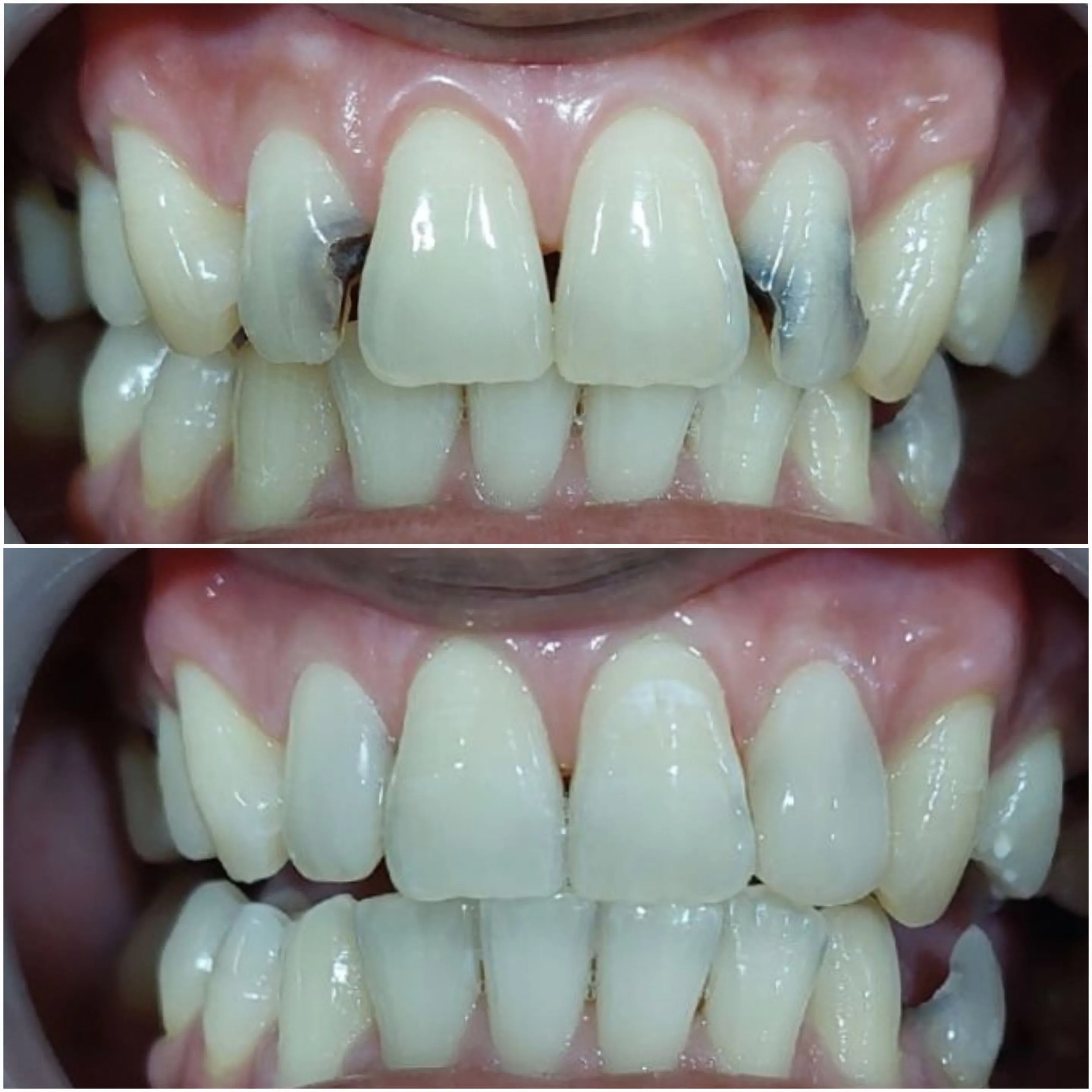 Root Canal Treatment in Bali Cost and Pain Level Uluwatu Dental Care Bali