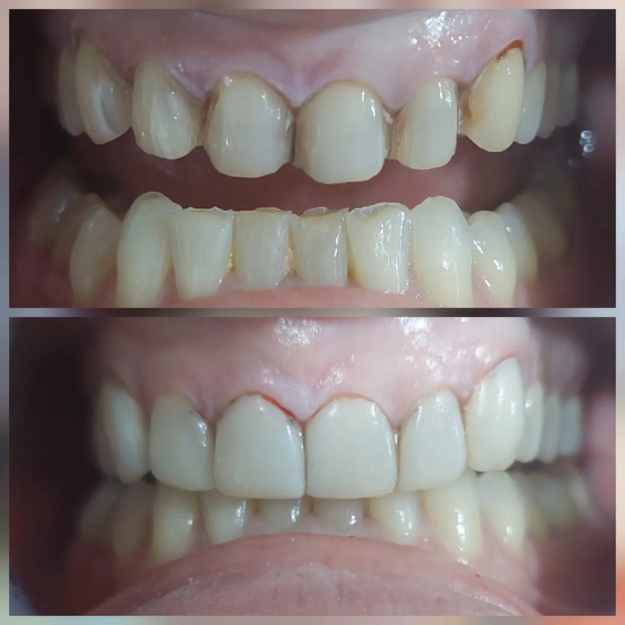 Porcelain dental veneers result at a Bali dental clinic
