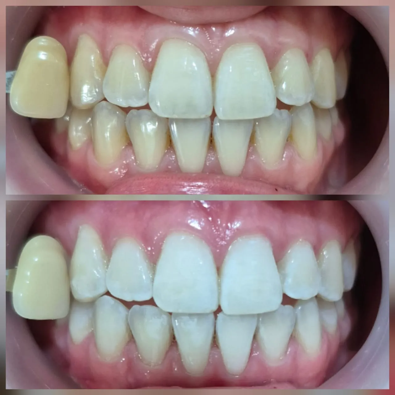 Professional teeth whitening result at a Bali dental clinic