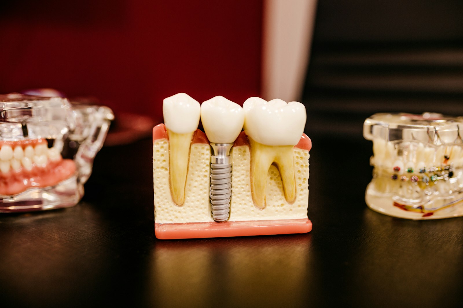 Dental implant model used to explain the procedure to patients in Bali