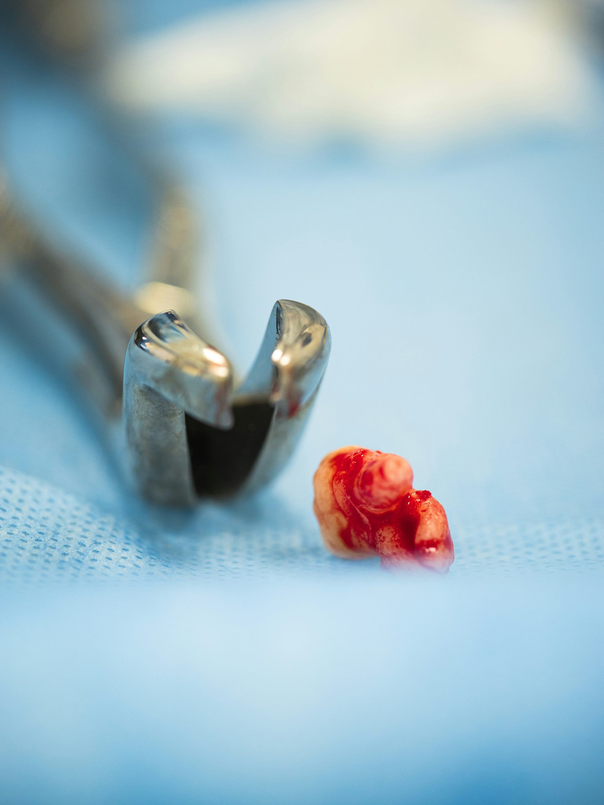 Tooth Extraction in Bali Safety and Recovery Uluwatu Dental Care Bali