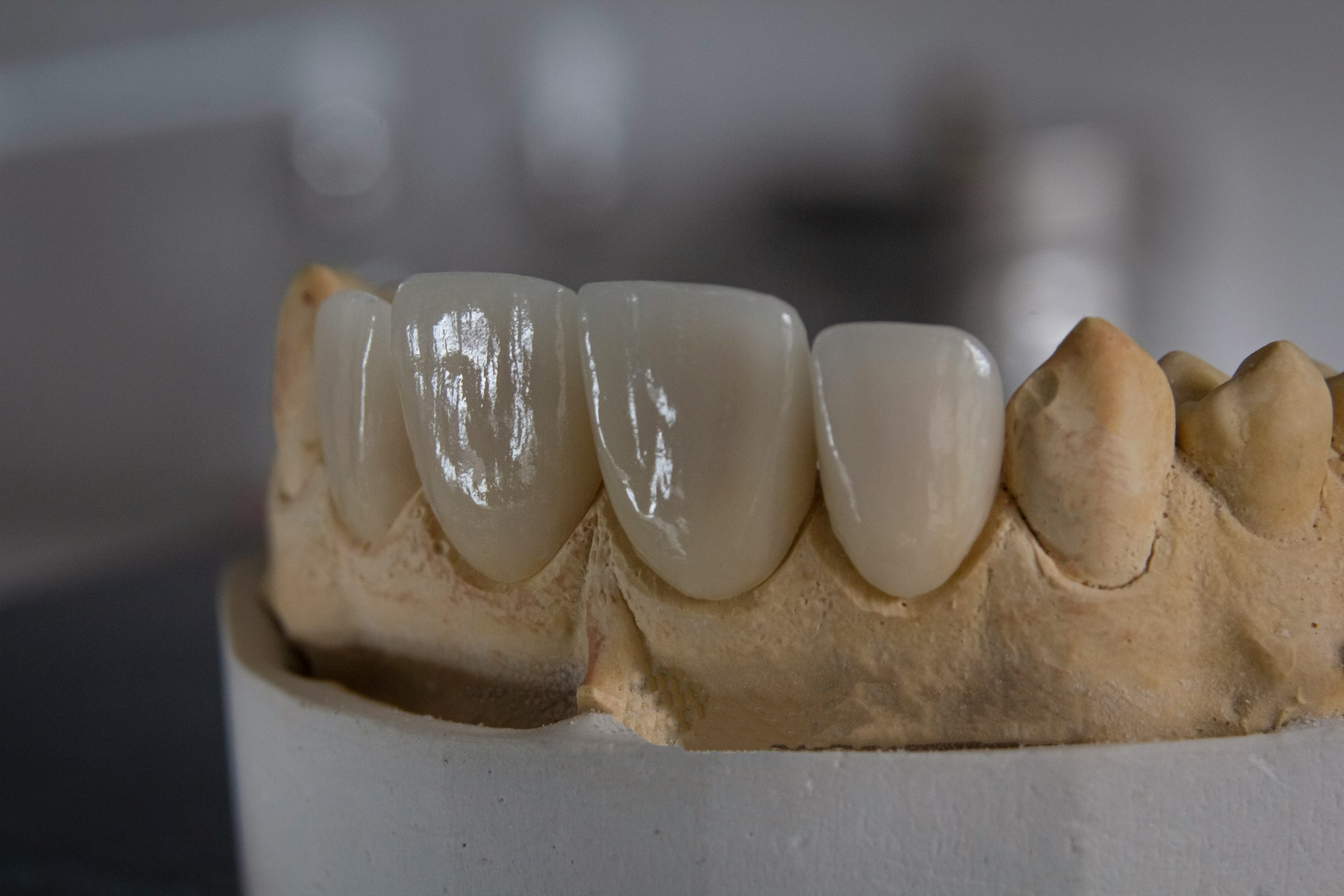 Dental Crowns and Bridges in Bali Uluwatu Dental Care Bali
